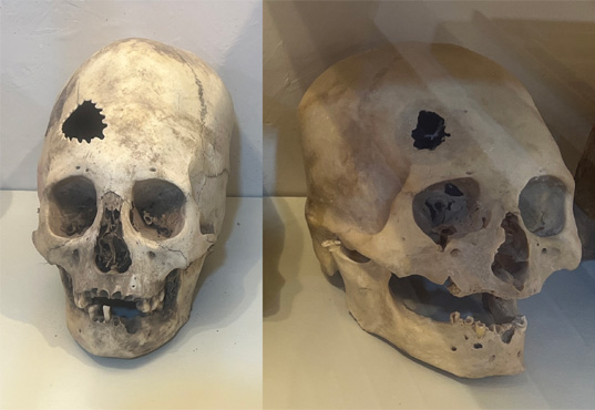 Trepanierte Sch�del im Textilmuseum.